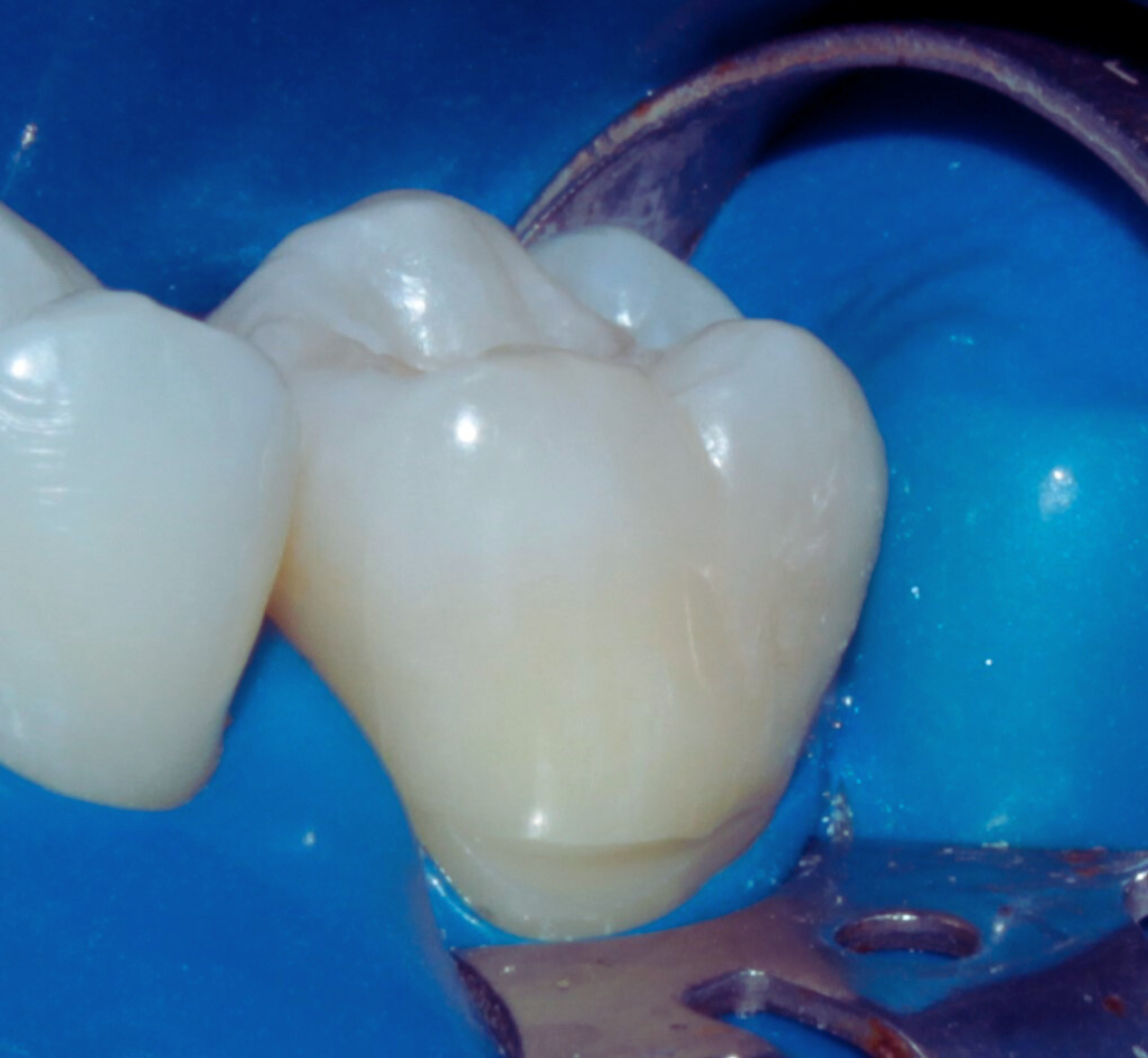 Close-up de um dente preparado para ser restaurado com resina composta, isolado com lençol de borracha azul. Procedimento odontológico detalhado para estética e funcionalidade do sorriso no sistema Dentista 24 horas nas consultas e urgência e emergência e agendamento de pacientes.