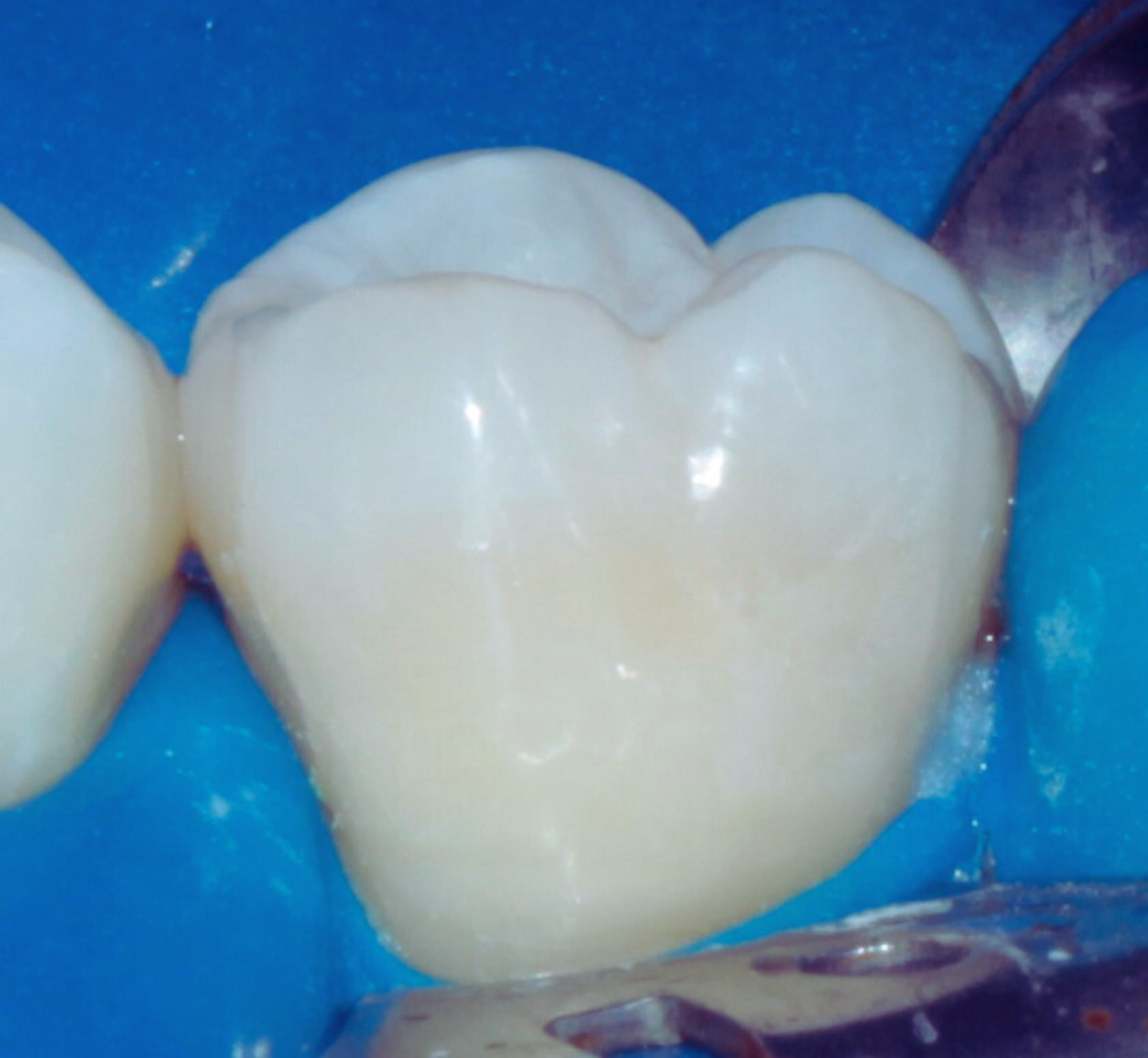 Close-up de um dente restaurado com resina composta, isolado com lençol de borracha azul. Procedimento odontológico detalhado para estética e funcionalidade do sorriso no sistema Dentista 24 horas nas consultas e urgência e emergência e agendamento de pacientes.