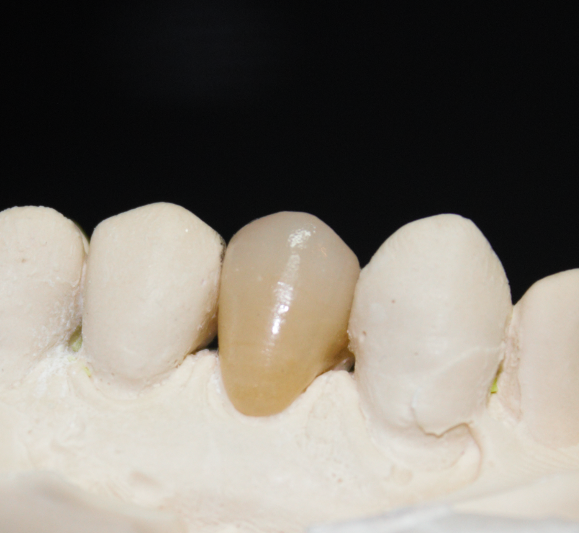 Modelo odontológico de gesso com uma coroa dentária protética posicionada, destacando a anatomia e adaptação da peça de cerâmica/porcelana. Trabalho realizado com agendamento prévio.