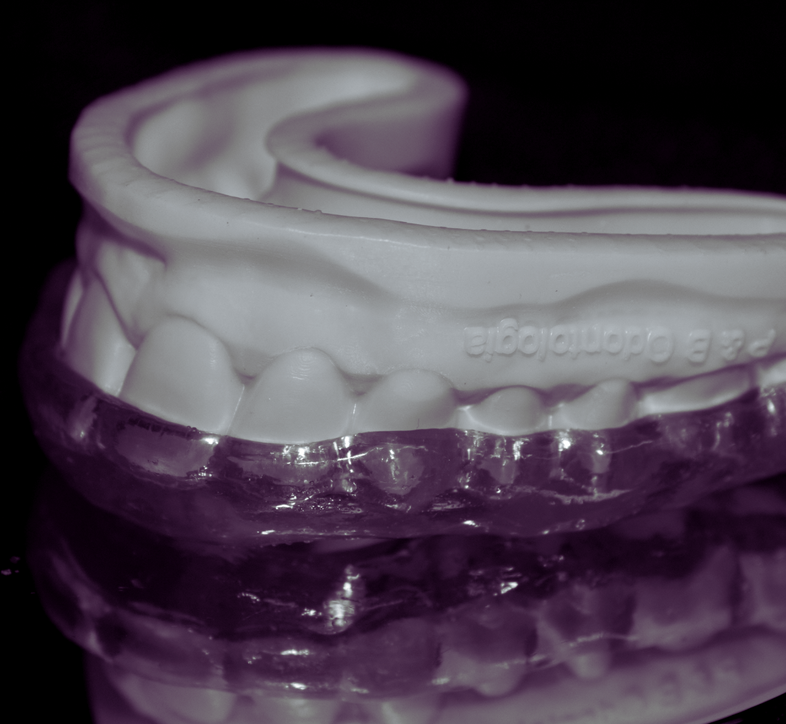 Placa de bruxismo (dispositivo interoclusal miorrelaxante) sendo provada em um modelo de Resina impressa de uma arcada dentaria de um paciente do sistema dentista 24 horas.