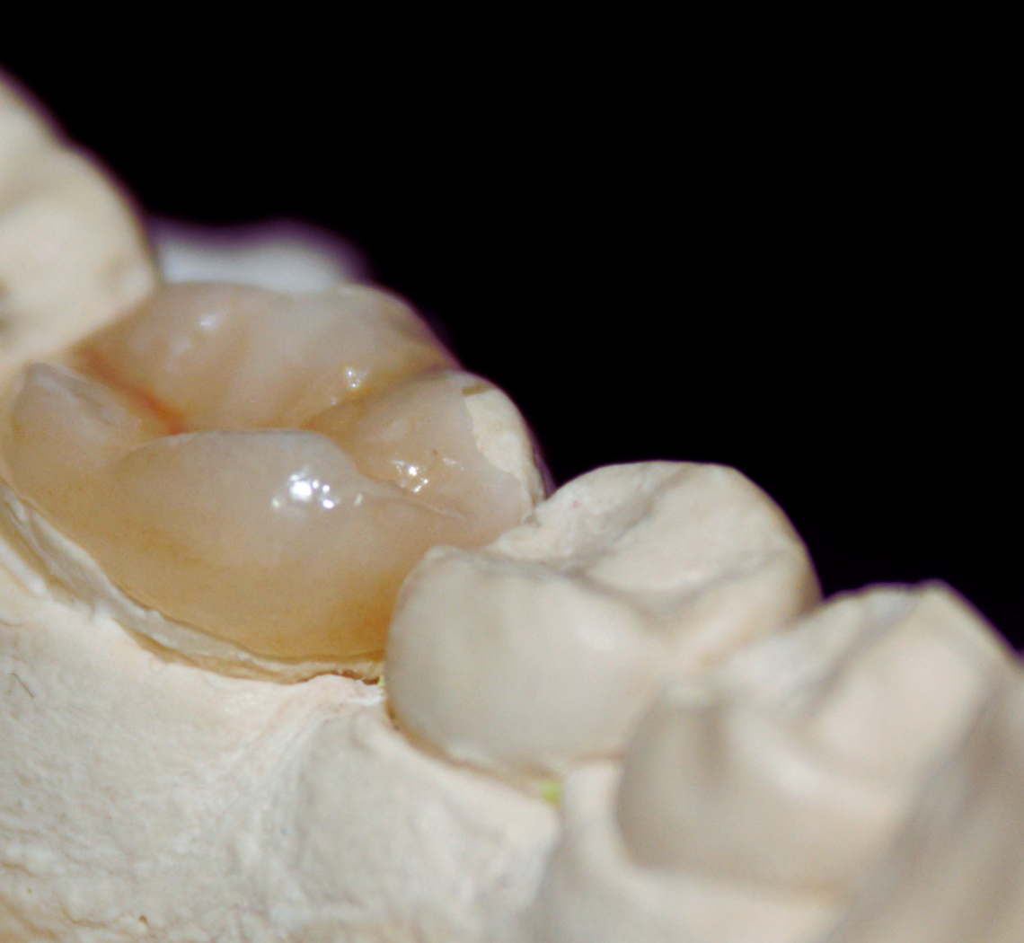 Modelo odontológico de gesso com uma peça protética posicionada, destacando a anatomia e adaptação da peça de cerâmica/porcelana.
