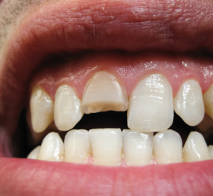 Imagem de um sorriso exibindo um dente frontal quebrado. A cena ilustra problemas odontológicos como fraturas dentárias, desgaste ou traumas bucais. Isso são possíveis causas da procura pelo sistema dentista 24 horas ou consultas de agendamento.