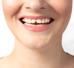 Imagem de um sorriso feminino com um dente incisivo quebrado. A cena destaca problemas odontológicos, como fraturas dentárias, que podem exigir tratamento estético ou restaurador, ilustrando possíveis causas da procura pelo sistema dentista 24 horas ou consulta de agendamento.
