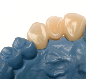 Modelo odontológico em gesso azul com coroas dentárias individuais, representando um trabalho de prótese ou restauração dentária, mostrando o que é oferecido no sistema dentista 24 horas.