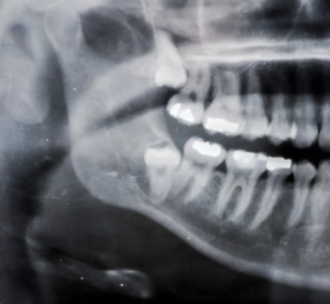 Radiografia panorâmica da arcada dentária, mostrando dentes, raízes e estruturas ósseas da mandíbula e maxila.